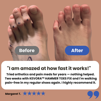 KEVORA™ HAMMER TOES FIX – Toe Straightener & Pain Relief