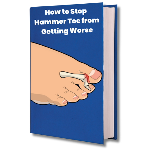 How to Stop Hammer Toe from Getting Worse